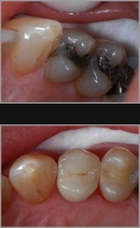 Composite Dental Fillings
