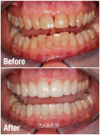 Dental Crown Before and After Photos