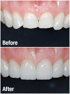 Dental Crowns in Annapolis MD