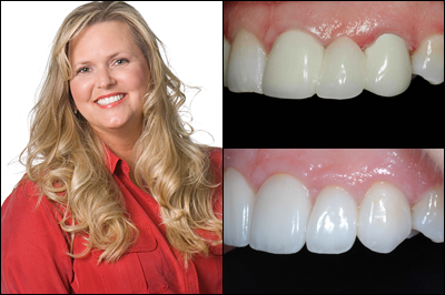 Dental Bridge Before and After Photos