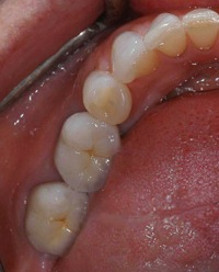 dental implants Annapolis