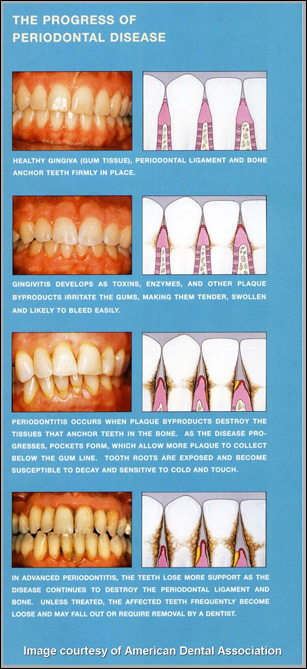 Periodontal Gum Chart