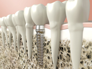 Affordable Dental Implants in Annapolis MD