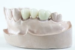 Which Dental Bridge is Right for Me in Annapolis Maryland