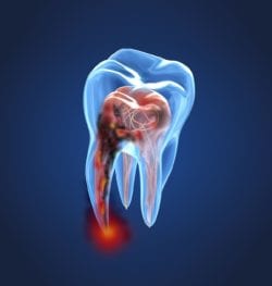 Root canal in Annapolis Maryland