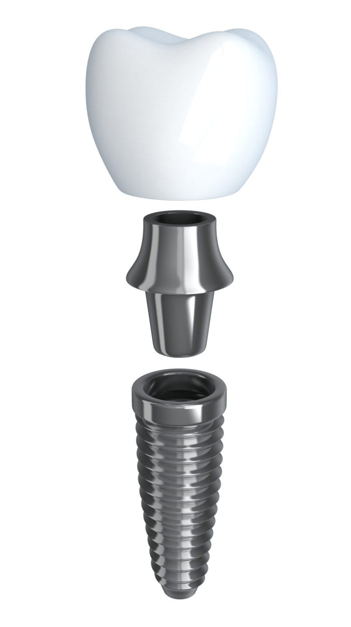 What is a dental implant? Annapolis MD Implant Dentist