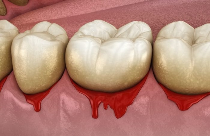 gum disease periodontal treatment in Annapolis Maryland