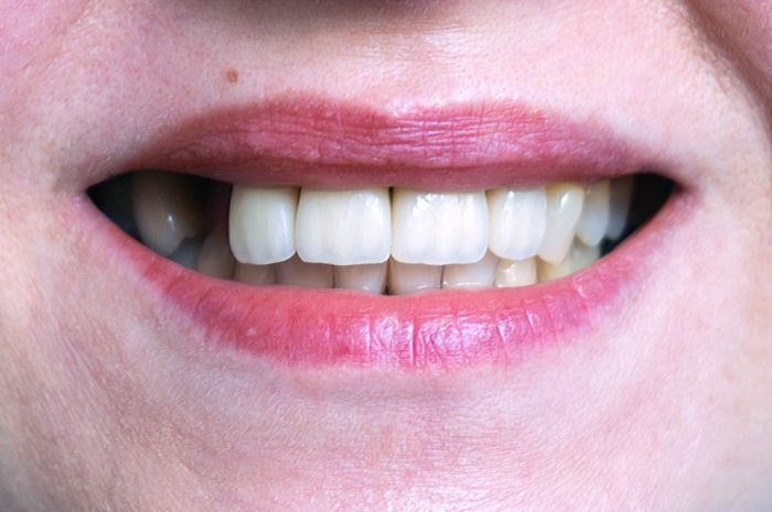 treat missing teeth with dental implants in Annapolis Maryland
