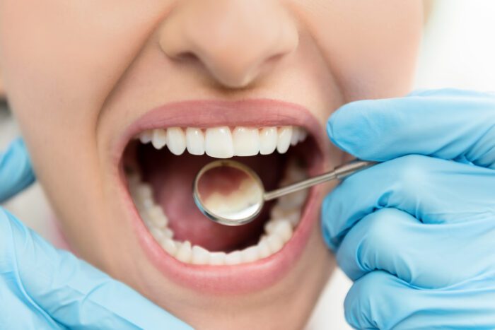 Tooth Cavities in Annapolis MD